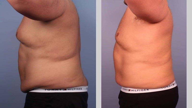 تاثیر جراحی شکم یا ابدومیناپلاستی